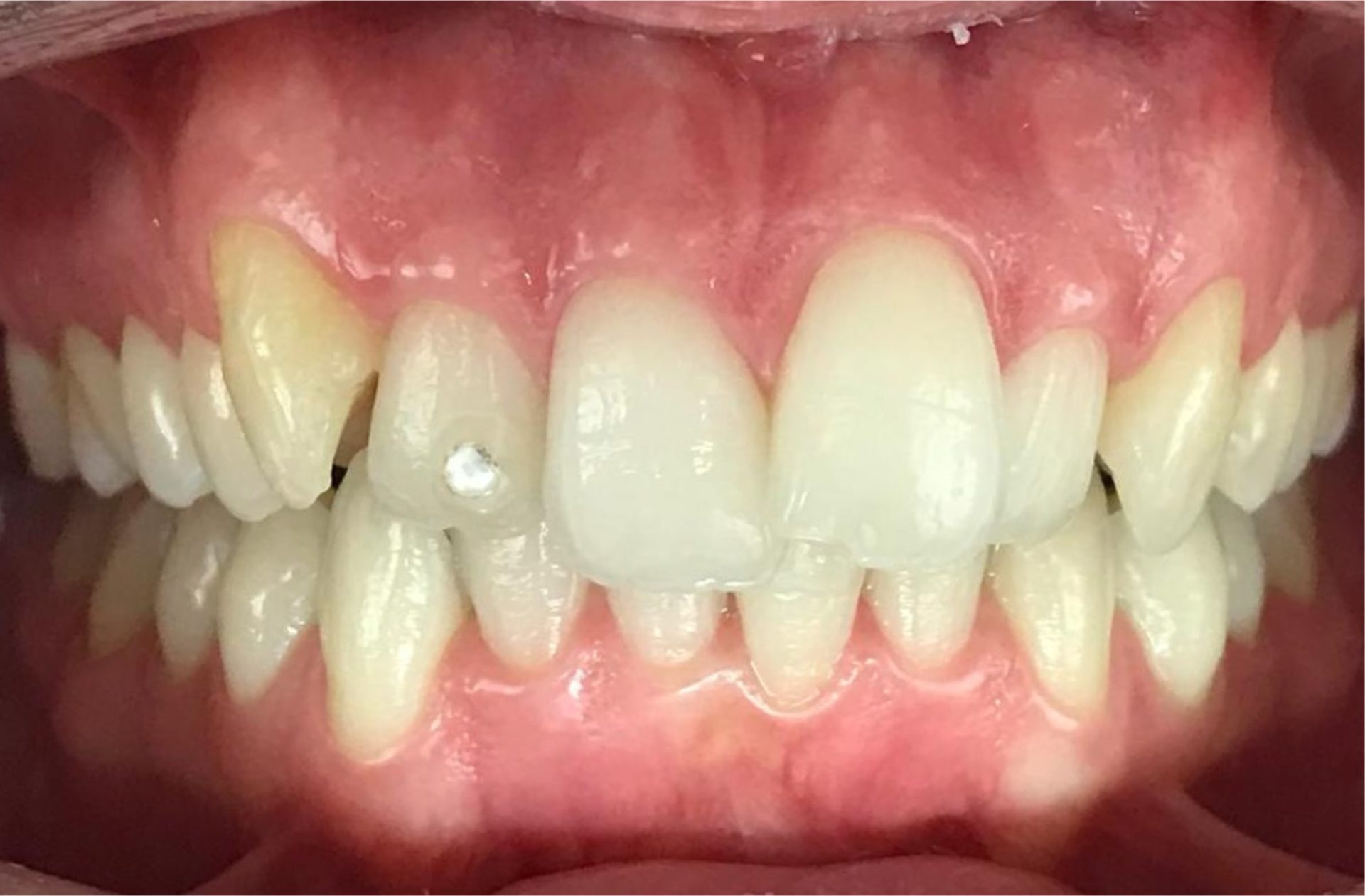 orthodontie avant après adulte