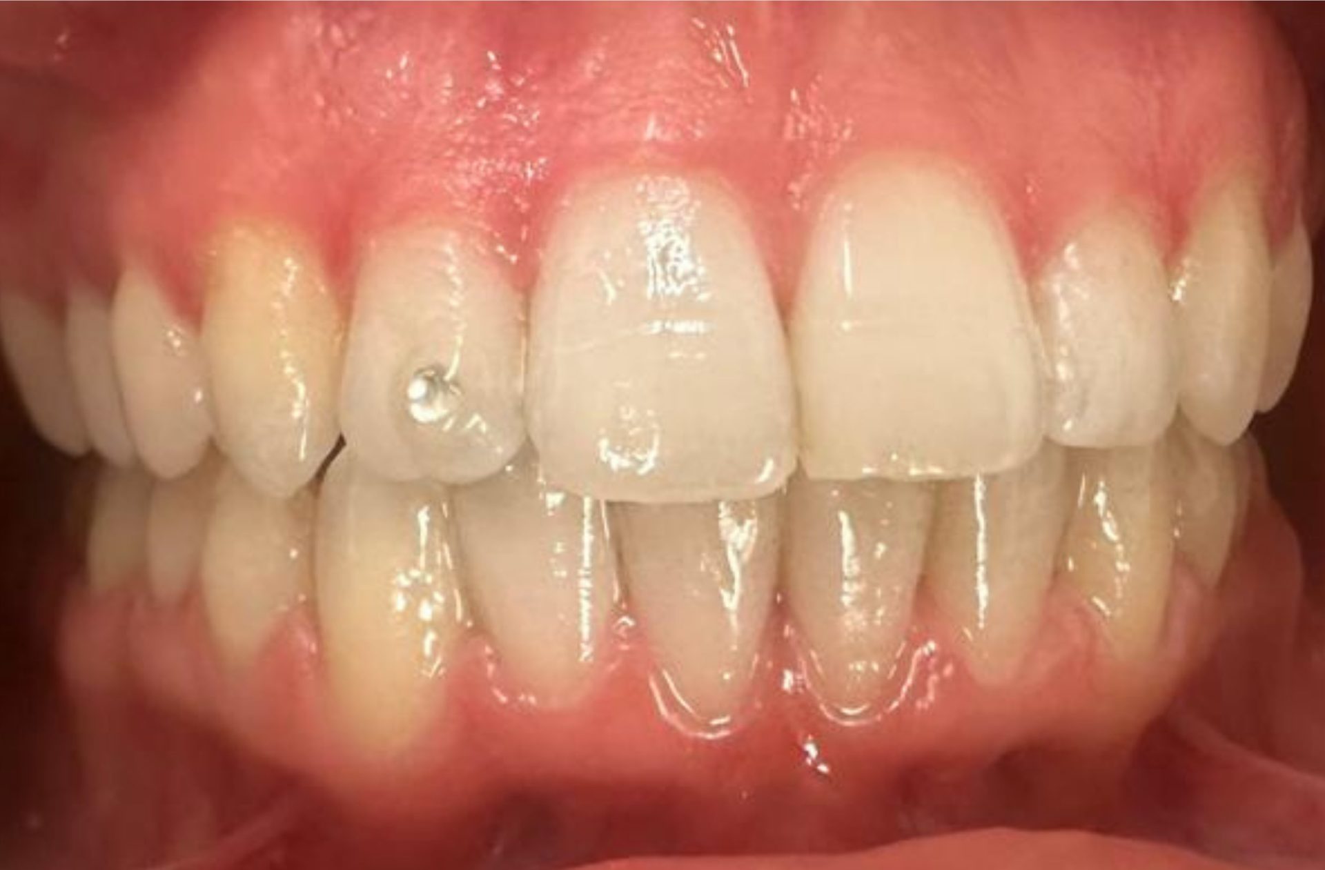 orthodontie avant après adulte