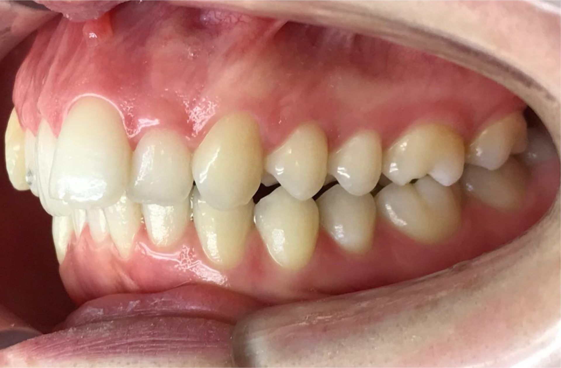 orthodontie avant après adulte