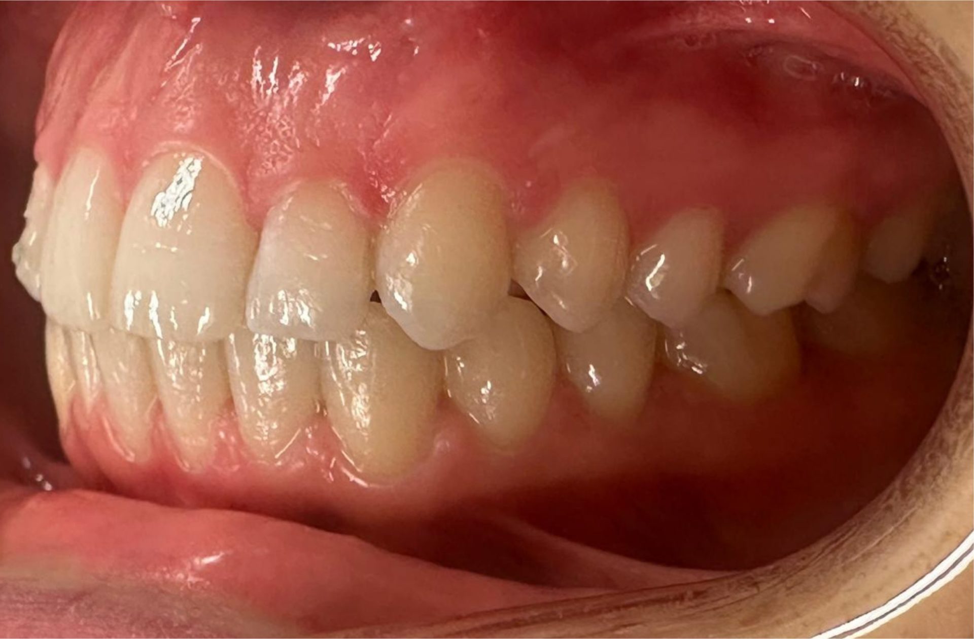 orthodontie avant après adulte