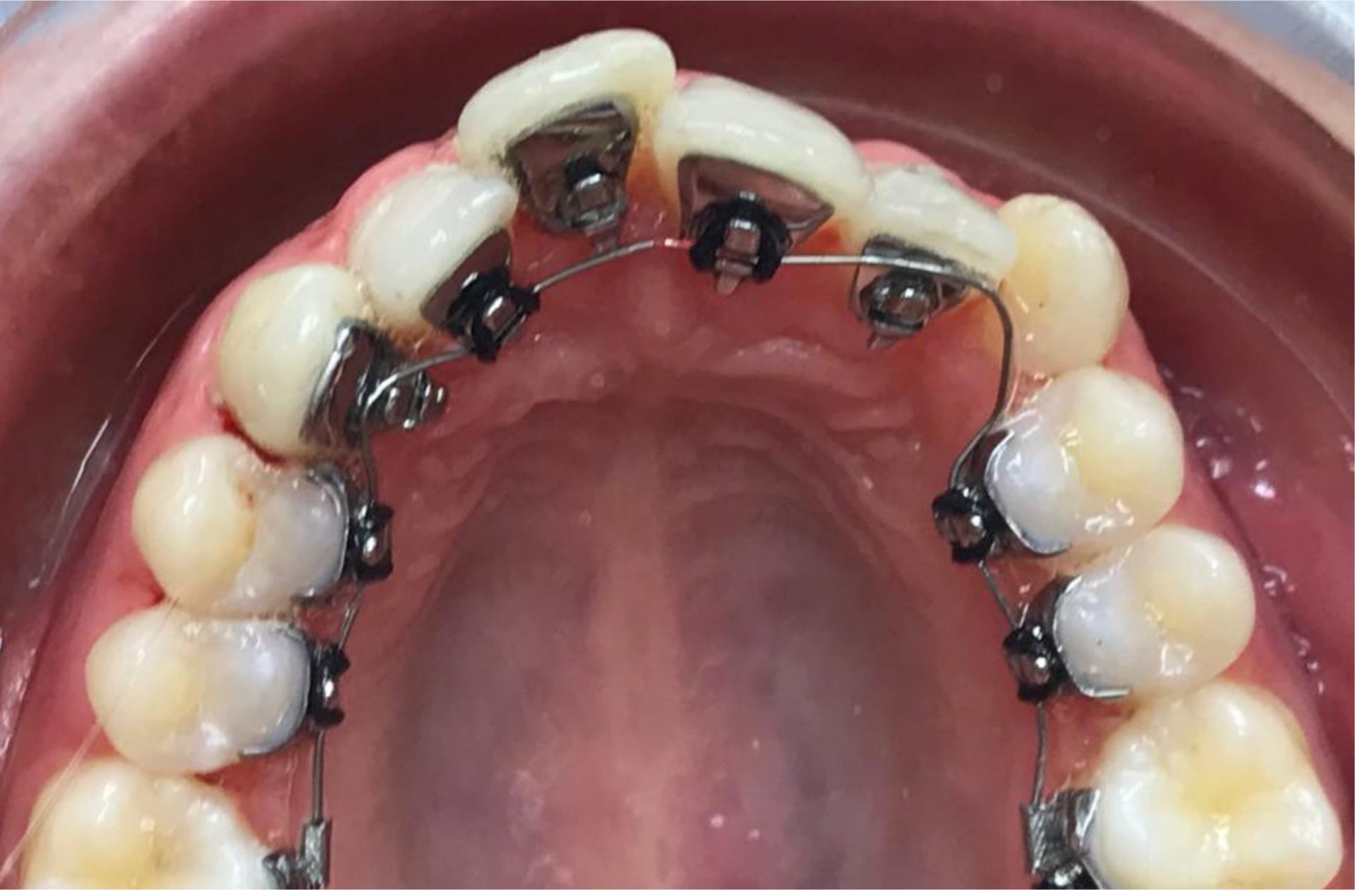 orthodontie avant après adulte