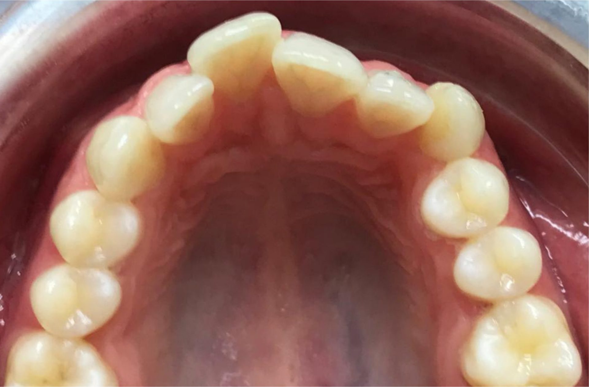 orthodontie avant après adulte