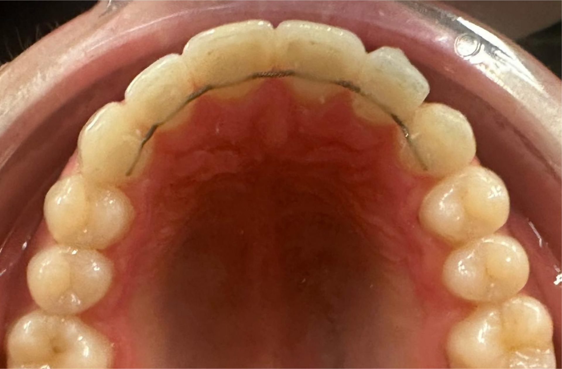 orthodontie avant après adulte