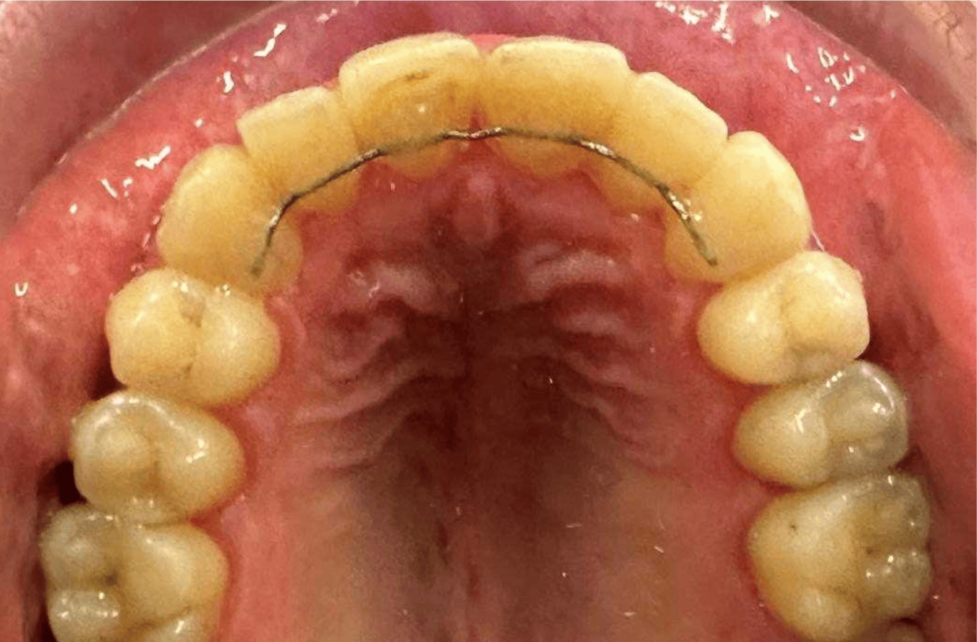 avant apres adulte 2 2